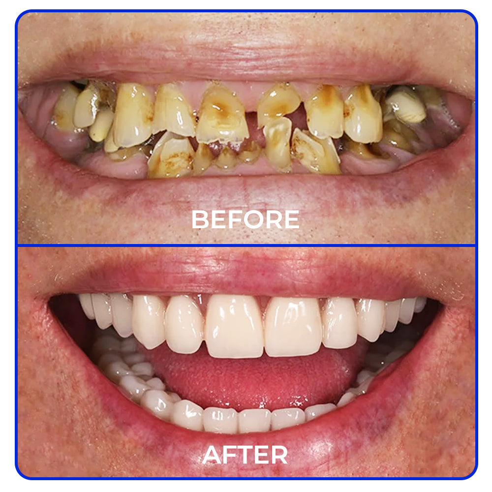 🦷 Furzero® Focussmile Bienengiftbehandlung Pulver zum Einnehmen(🇩🇪 BZÄK Zugelassen)