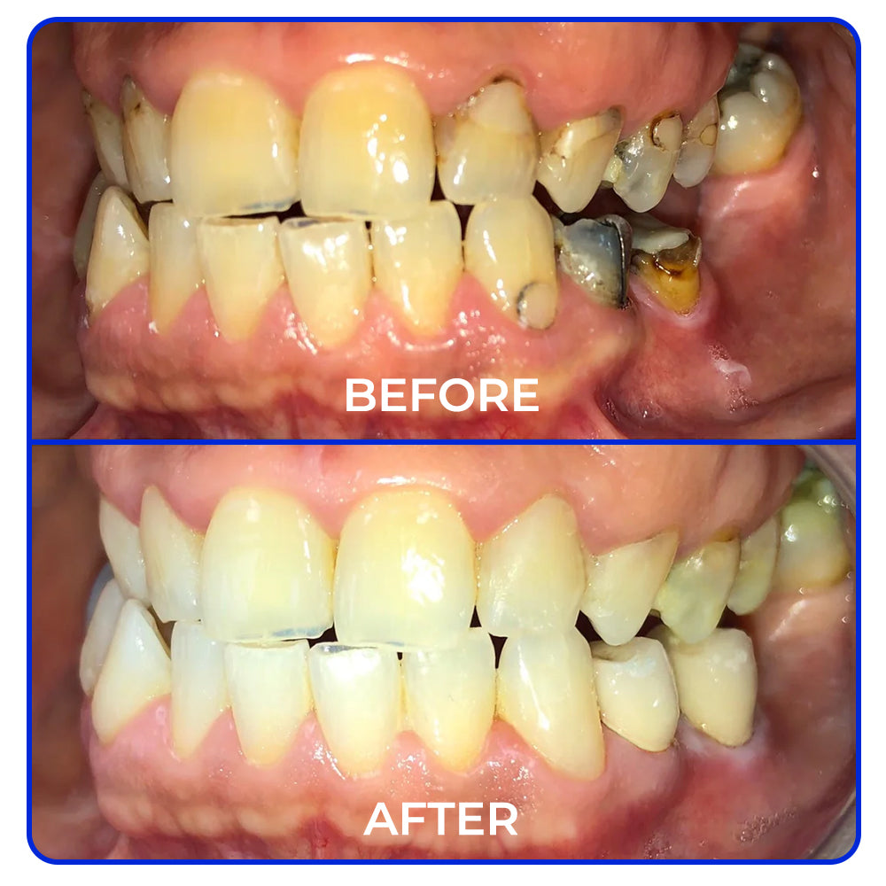 🦷 Furzero® Focussmile Bienengiftbehandlung Pulver zum Einnehmen(🇩🇪 BZÄK Zugelassen)