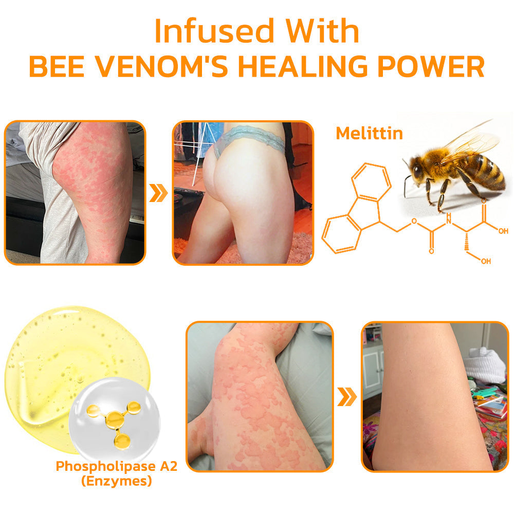 Furzero™ Urtikaria Bienengift Therapie Creme