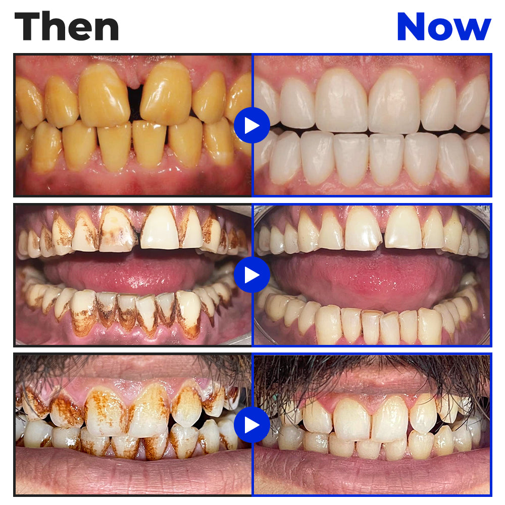 🦷 Furzero® Focussmile Bienengiftbehandlung Pulver zum Einnehmen(🇩🇪 BZÄK Zugelassen)