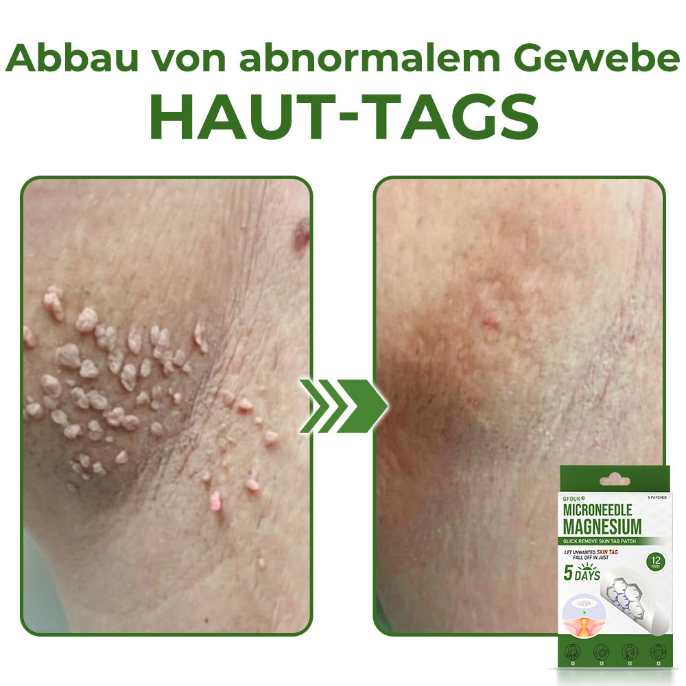 GFOUK® Magnesium MicroNeedle Schnell-Entfernungspflaster für Hautstellen
