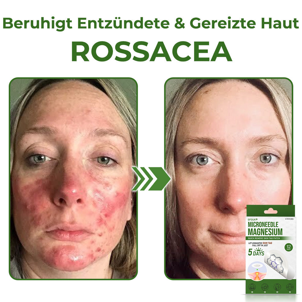 GFOUK® Magnesium MicroNeedle Schnell-Entfernungspflaster für Hautstellen