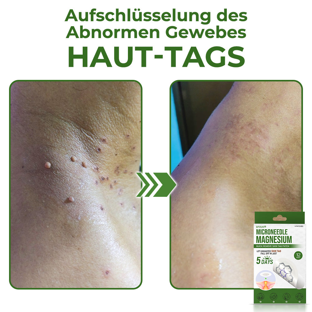 GFOUK® Magnesium MicroNeedle Schnell-Entfernungspflaster für Hautstellen
