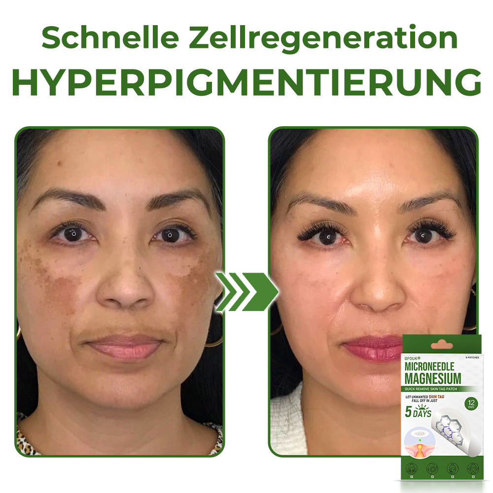 GFOUK® Magnesium MicroNeedle Schnell-Entfernungspflaster für Hautstellen