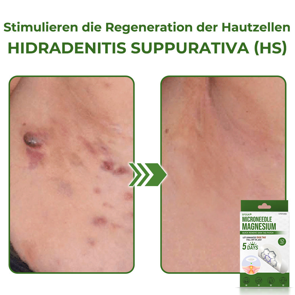 GFOUK® Magnesium MicroNeedle Schnell-Entfernungspflaster für Hautstellen