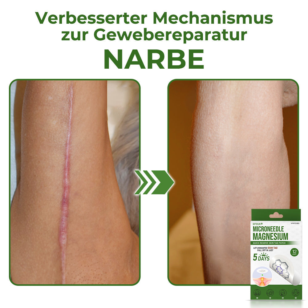 GFOUK® Magnesium MicroNeedle Schnell-Entfernungspflaster für Hautstellen