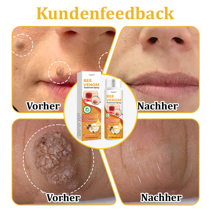 🐝Furzero™ Bienengift-Therapie-Spray(✅Dermatest-Zertifizierung)