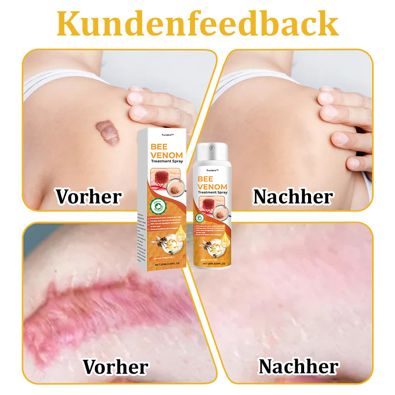 🐝Furzero™ Bienengift-Therapie-Spray(✅Dermatest-Zertifizierung)