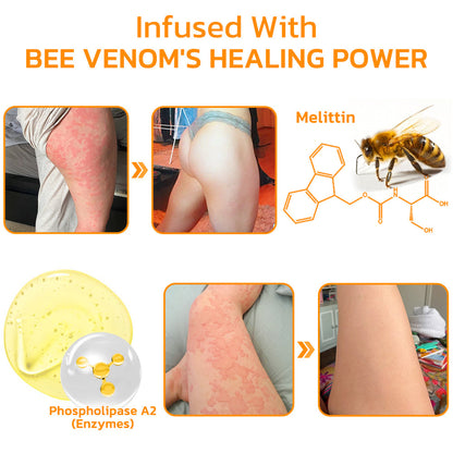 Furzero™ Urtikaria Bienengift Therapie Creme