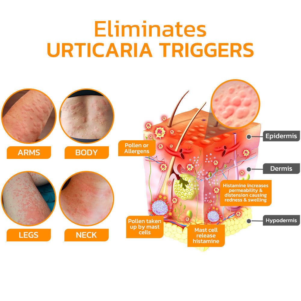 Furzero™ Urtikaria Bienengift Therapie Creme