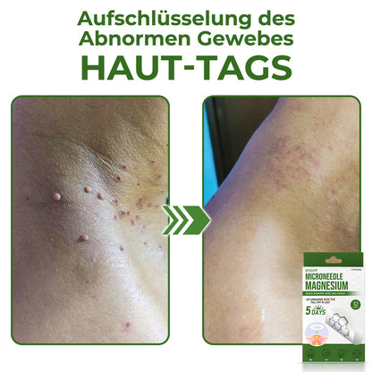 GFOUK® Magnesium MicroNeedle Schnell-Entfernungspflaster für Hautstellen
