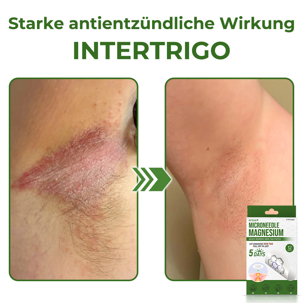 GFOUK® Magnesium MicroNeedle Schnell-Entfernungspflaster für Hautstellen