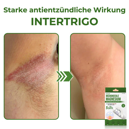 GFOUK® Magnesium MicroNeedle Schnell-Entfernungspflaster für Hautstellen