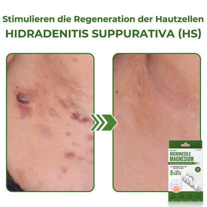GFOUK® Magnesium MicroNeedle Schnell-Entfernungspflaster für Hautstellen