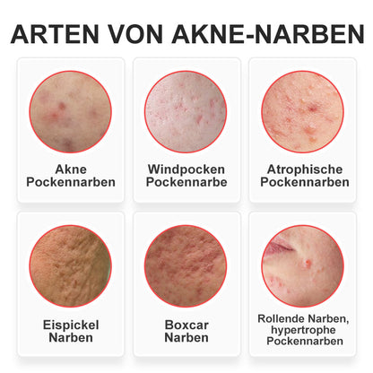 flysmus™ Niacinamid Pockmark Repair Essenz