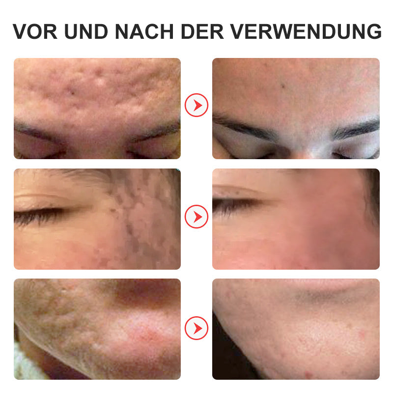 flysmus™ Niacinamid Pockmark Repair Essenz